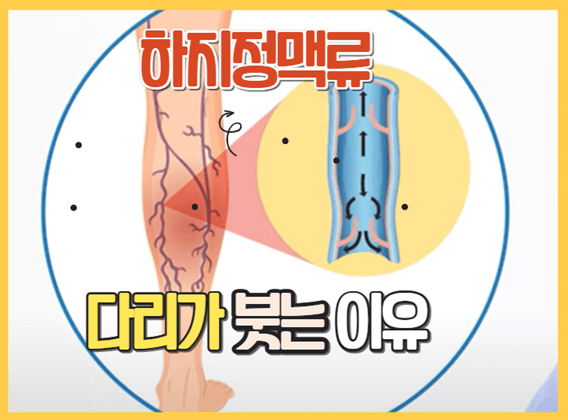 하지정맥류-다리가-붓는-이유