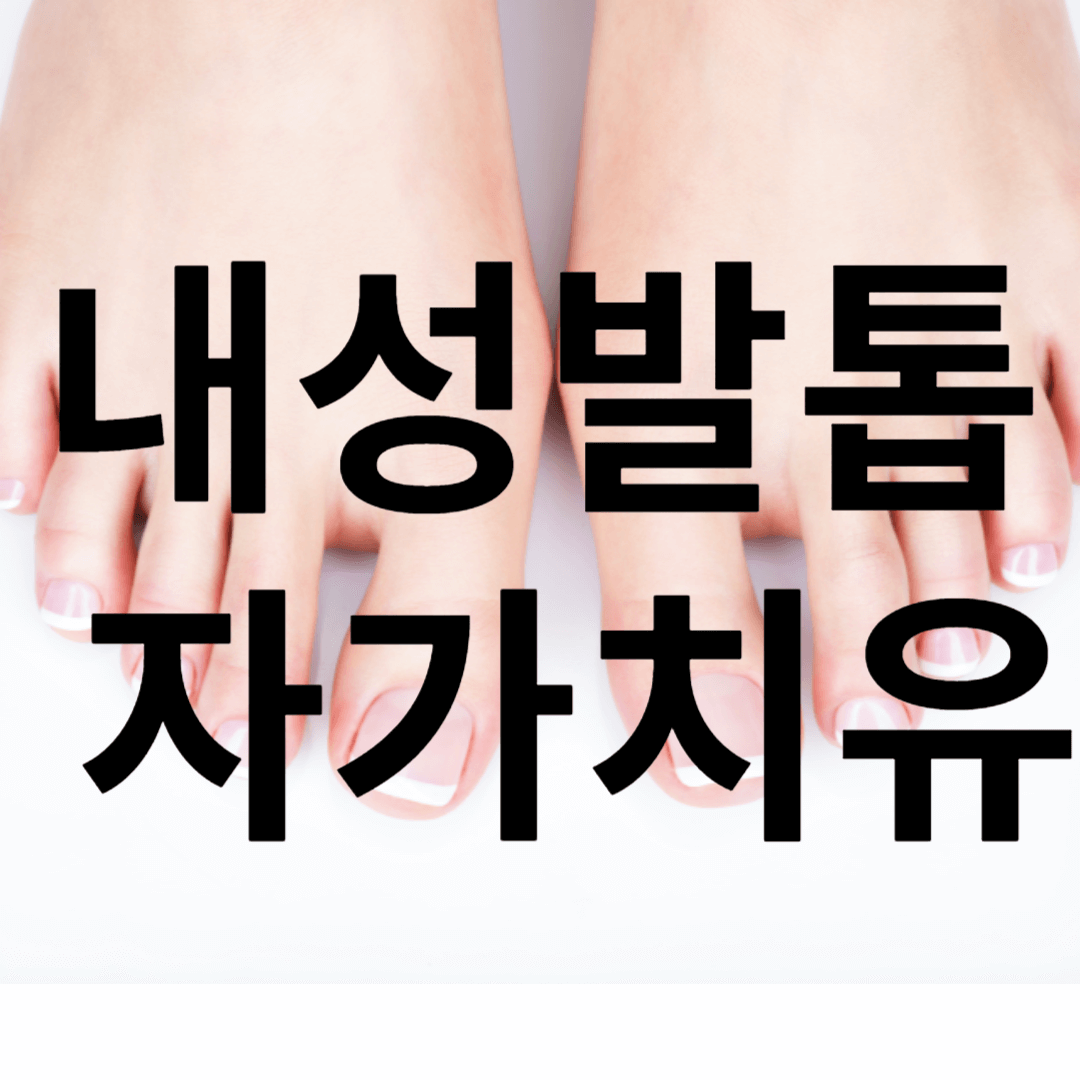 내성발톱 자가치료