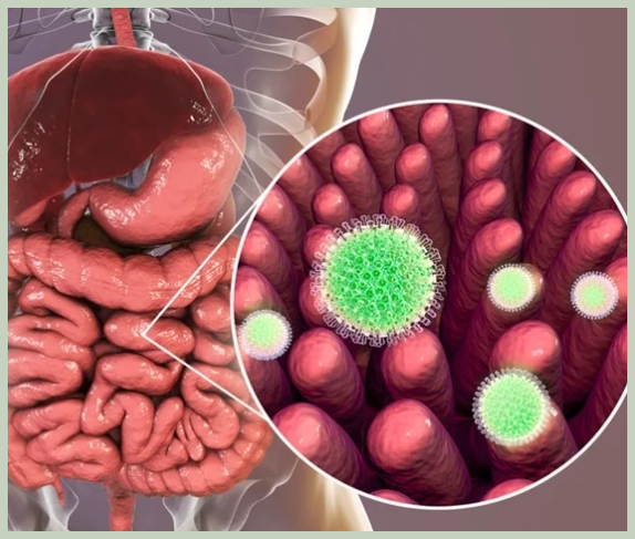 노로바이러스 치료