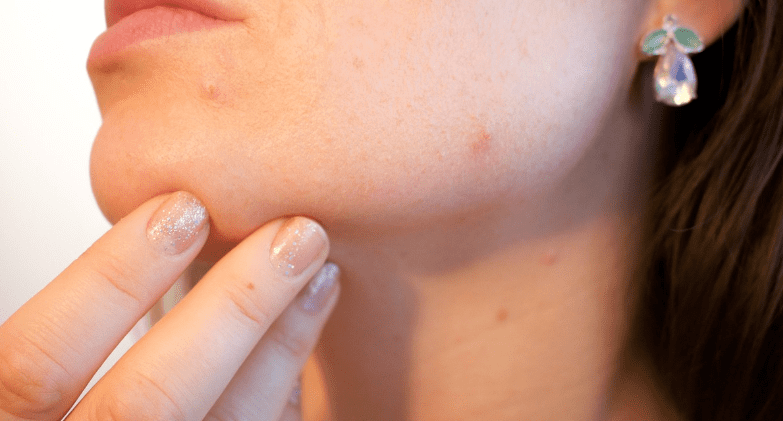 턱에 여드름이 있는 여성