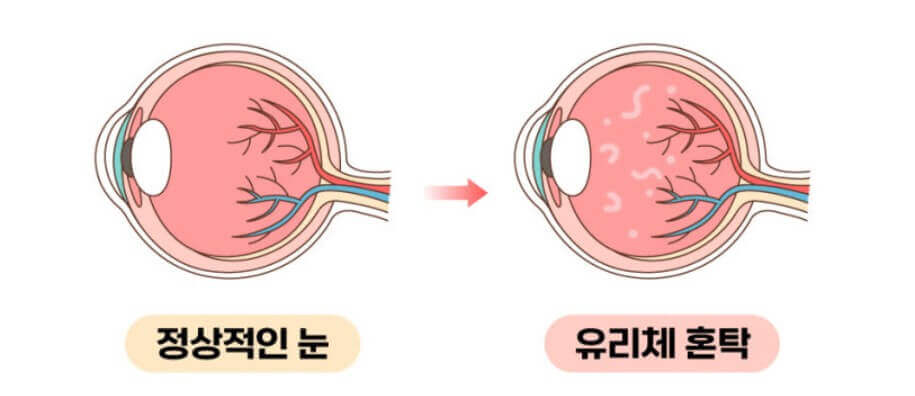 유리체 현상 설명하는 사진