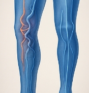 하지 정맥류 증상