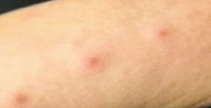 모기 물려서 가려울 때