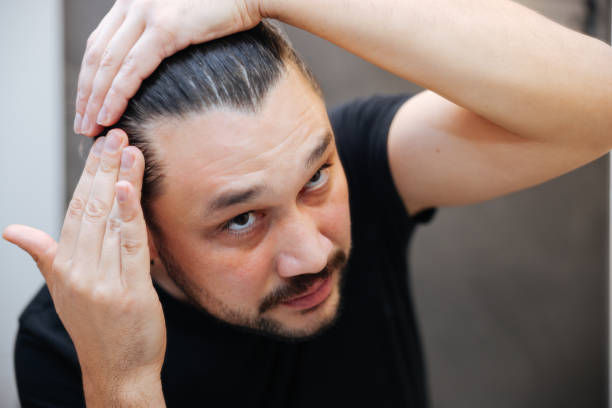 모발이식 후 이식된 헤어라인을 살펴보는 남성, 이식 부위 촉감 및 성장 확인