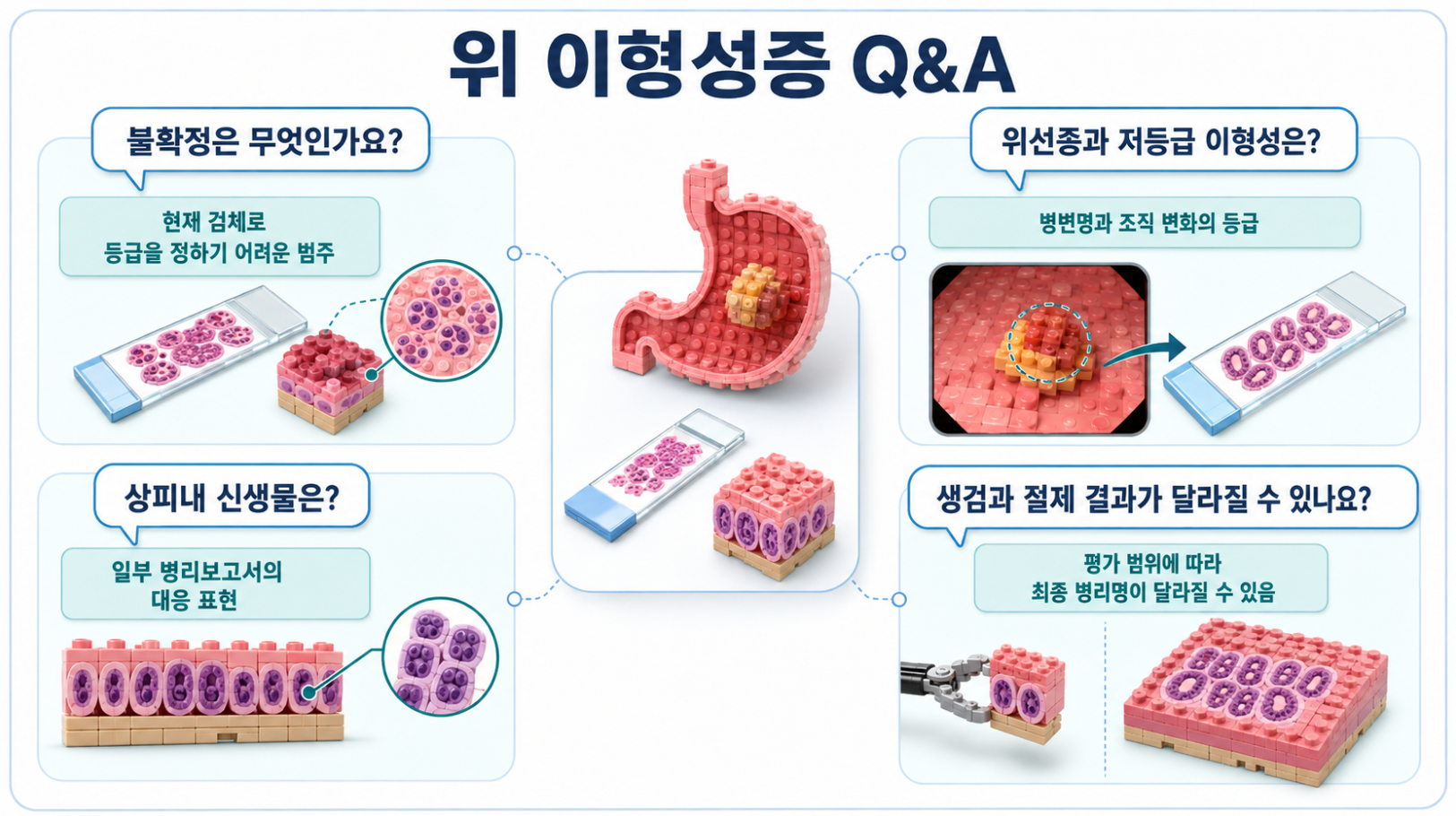 위 이형성증 불확정&middot;위선종&middot;상피내 신생물과 생검&middot;절제 결과 차이 Q&amp;A