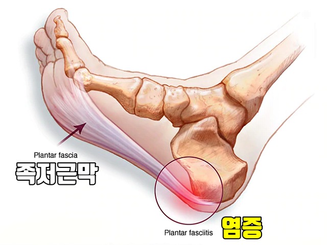 발바닥 뒤꿈치 통증 찌릿찌릿 족저근막염 원인, 아플때 하는 운동, 팁줌