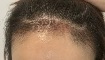 머리카락 이식 3000모 3000모낭 비용과 시술 과정_21