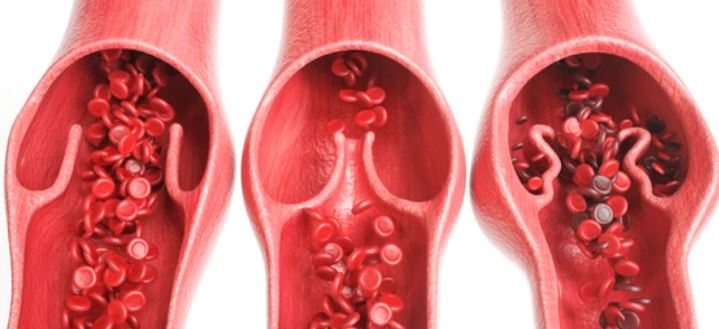 하지정맥류 증상