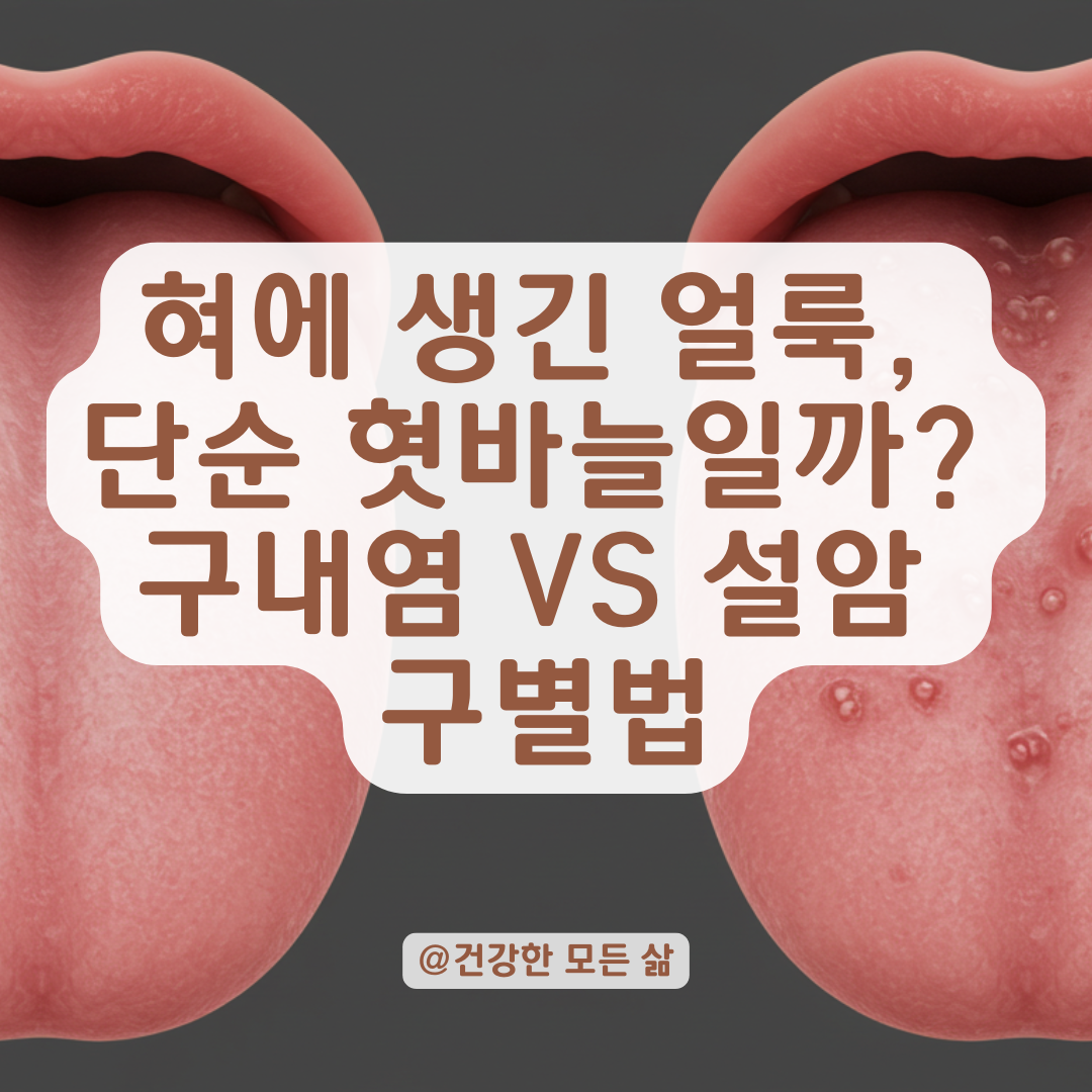 혓바늘이 오래가고 혀에 얼룩이 생겼다면? 설암과 구내염 증상 차이 정리.