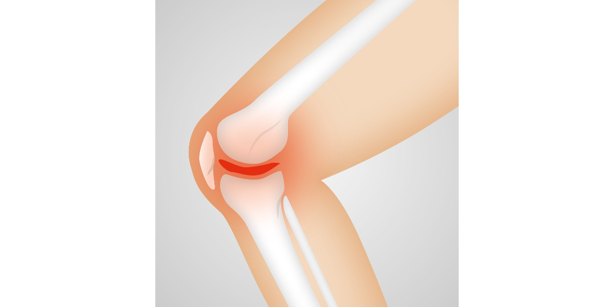 무릎관절염 원은, 증상