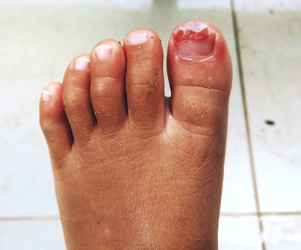 발톱이 얇아지고 뒤집히는 비밀, 건강한 발톱을 위한 완벽 가이드2