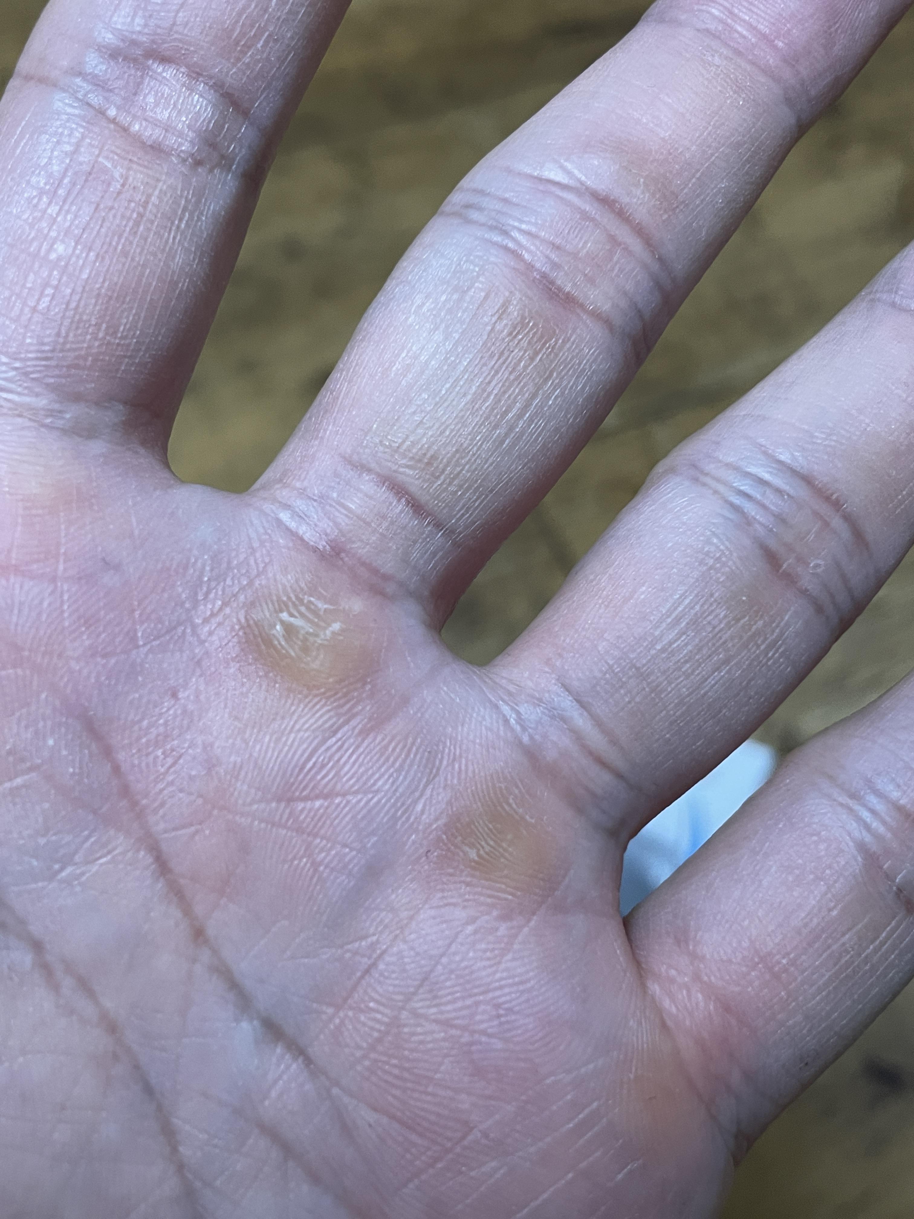 손바닥 굳은살 제거기