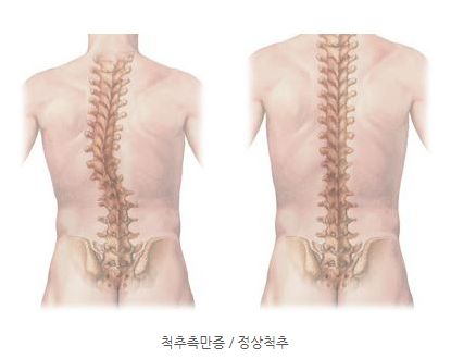 척추측만증 증상