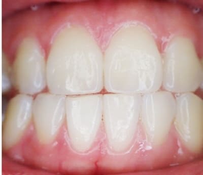 잇몸이-변색되는이유