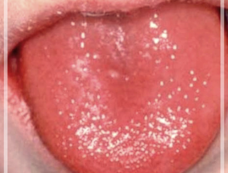 딸기혀 질병일명 가와사키병 원인 증상 치료에 모든 정보