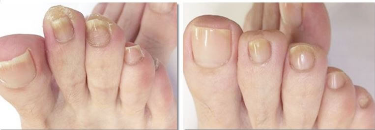 발톱 무좀 치료 후 호전 상태