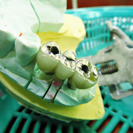 임플란트 시술과정 단계별 설명13