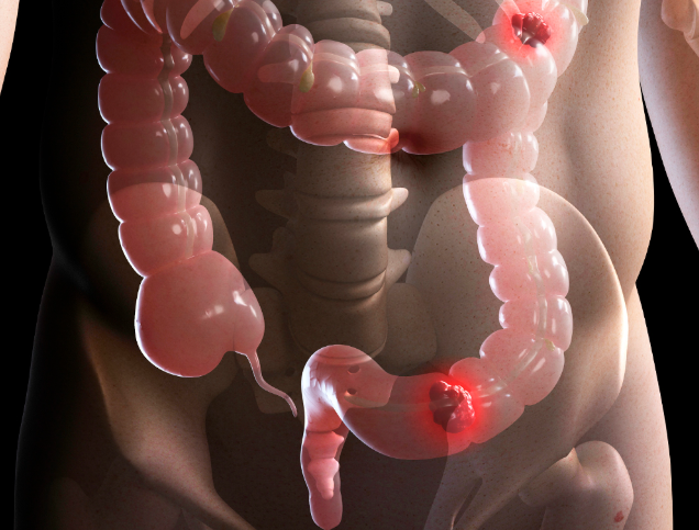 크론병 소아청소년크론병 경장영양 크론병치료 완전경장영양 소화기질환 크론병관리 경장영양지원 장건강 염증성장질환
