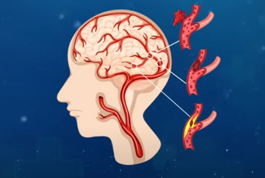 뇌에 혈액이 공급되지 않아 발생하는 혈관성 치매