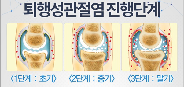 퇴행성관절염