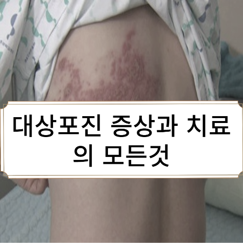 대상포진 증상