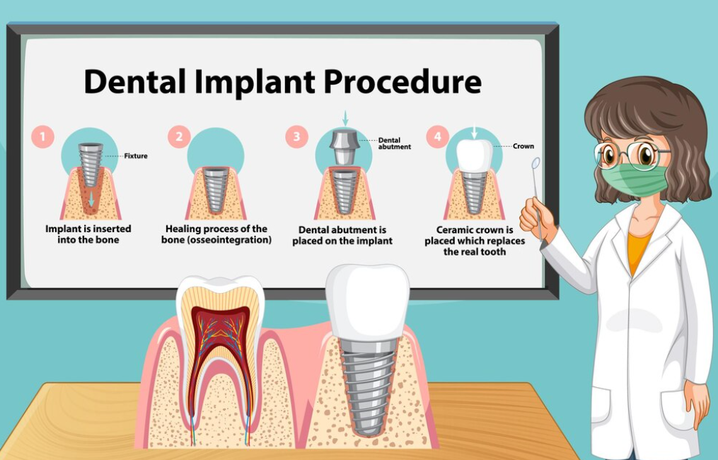 임플란트 시술의 절차를 보여주는 여성 캐릭터
