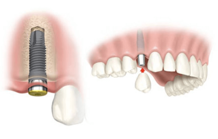 앞니 임플란트 후기