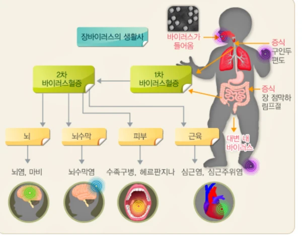 수족구병 증상