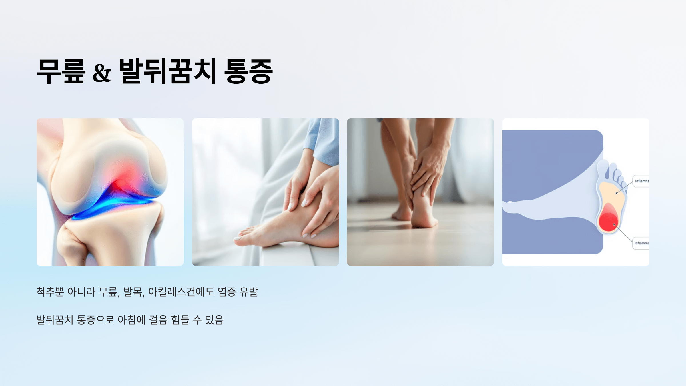 강직성 척추염과 관련된 사진입니다.