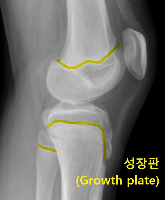 엘스레이 사진에 성장판이 표시되어 있다.