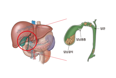 담석증 증상