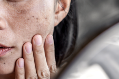 기미 주근깨 차이