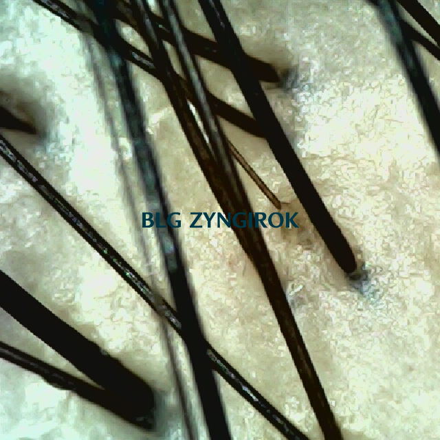 피나모아 복용 22주차 - 정수리 위치 두피 모습이다.