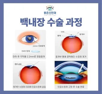 백내장 수술 비용 실비 보험 청구 회복기간_11