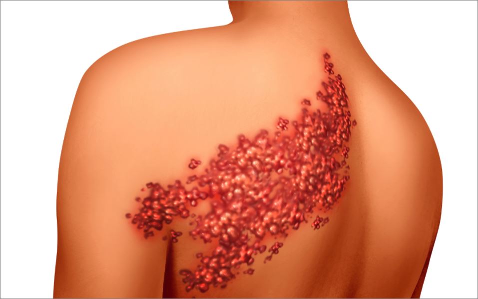 대상포진(Herpes zoster) 초기증상