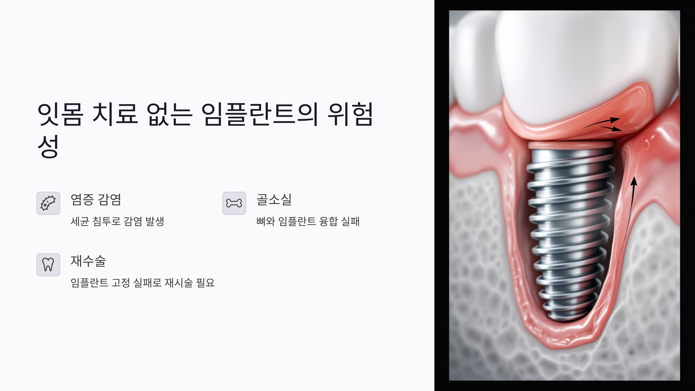 잇몸 치료 없이 임플란트를 하면 생기는 문제