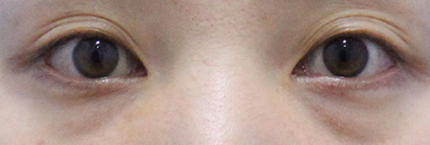 눈밑 지방재배치 비용과 회복기간