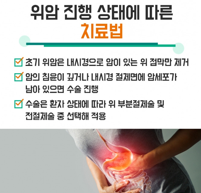alt="위암 진행상태에 따른 치료법"