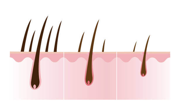 미녹시딜 여자 남자 효능&amp;#44; 탈모치료제 미녹시딜은 지난 몇년간 대세가 되어 온 탈모치료제 중 하나입니다. 미녹시딜은 남성형 탈모와 여성형 탈모 모두에게 효과가 있으며&amp;#44; 외용제 형태로 발매되고 있습니다. 이 글에서는 미녹시딜의 작용 메커니즘&amp;#44; 사용법&amp;#44; 주의사항 등을 자세하게 알아보도록 합니다.