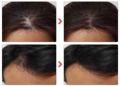 탈모 예방 광고