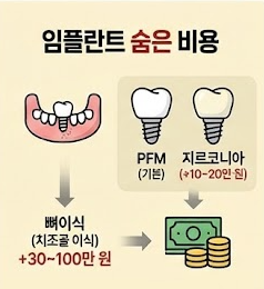 임플란트 숨은 비용