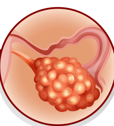 다낭성난소증후군