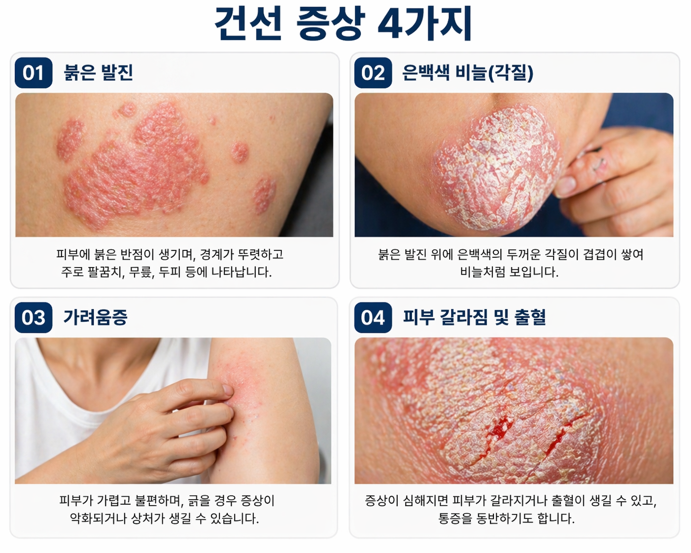 피부건선 증상.원인.치료