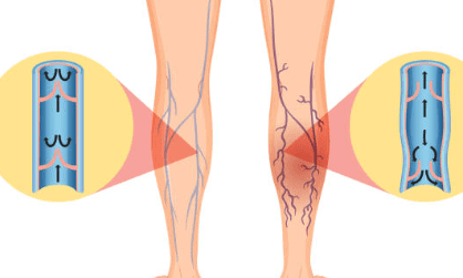 하지 정맥류 증상 수술비용