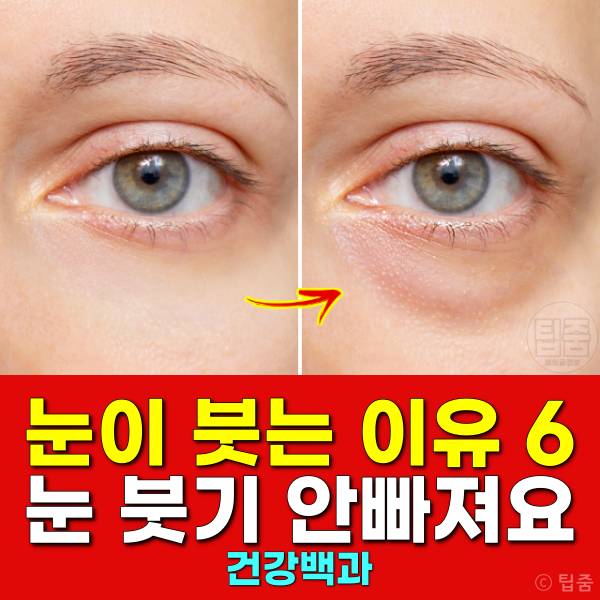 눈이 붓는 이유 눈 붓기가 안빠져요 눈붓기 원인