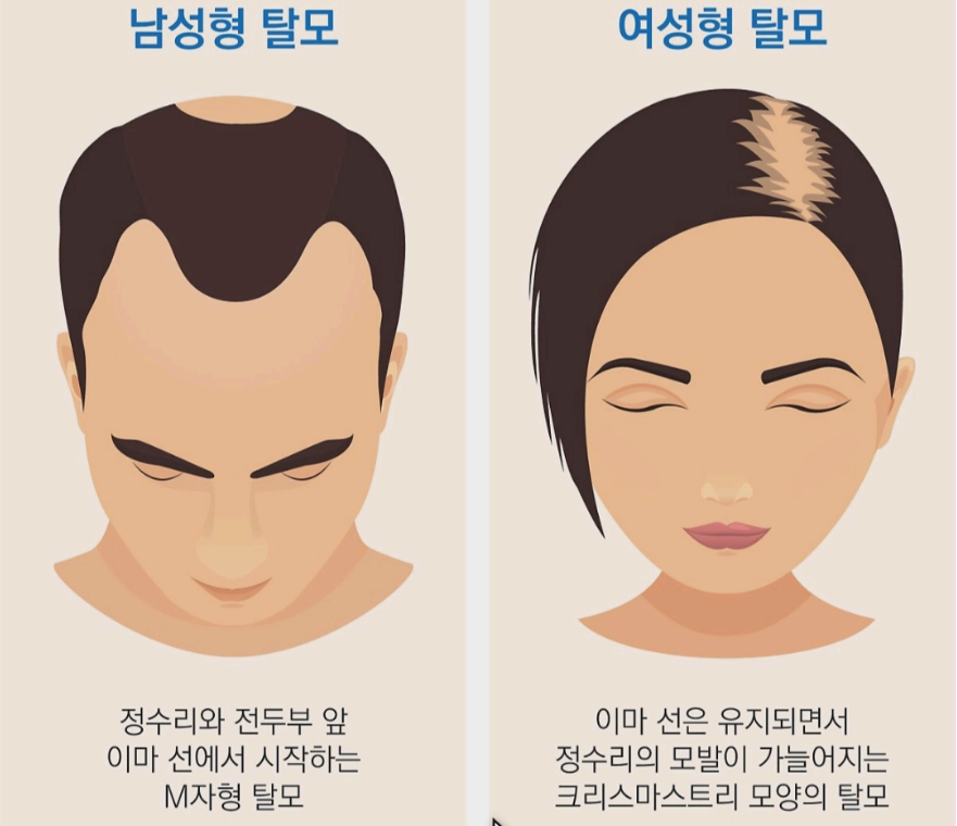 탈모 유형