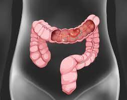 대장암 초기증상