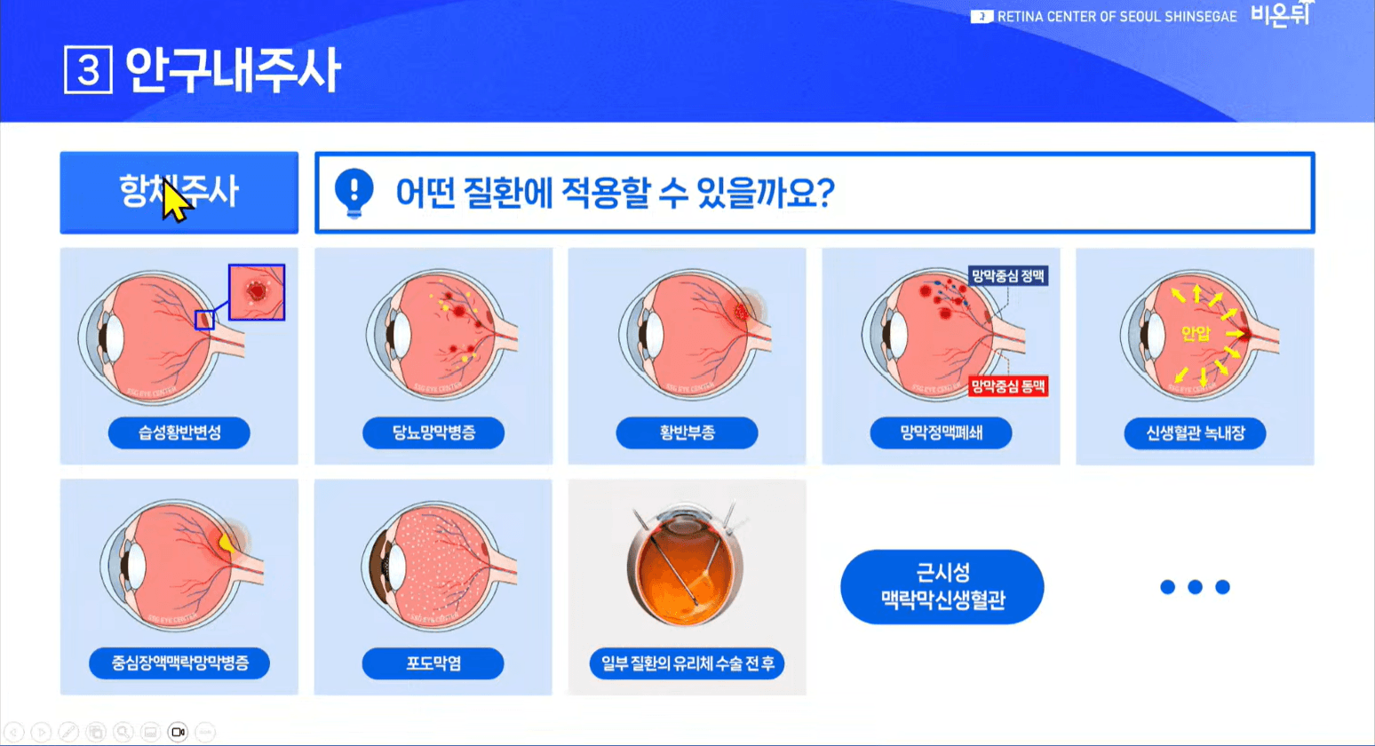 황반변성의 치료 중 안구내 주사 방법