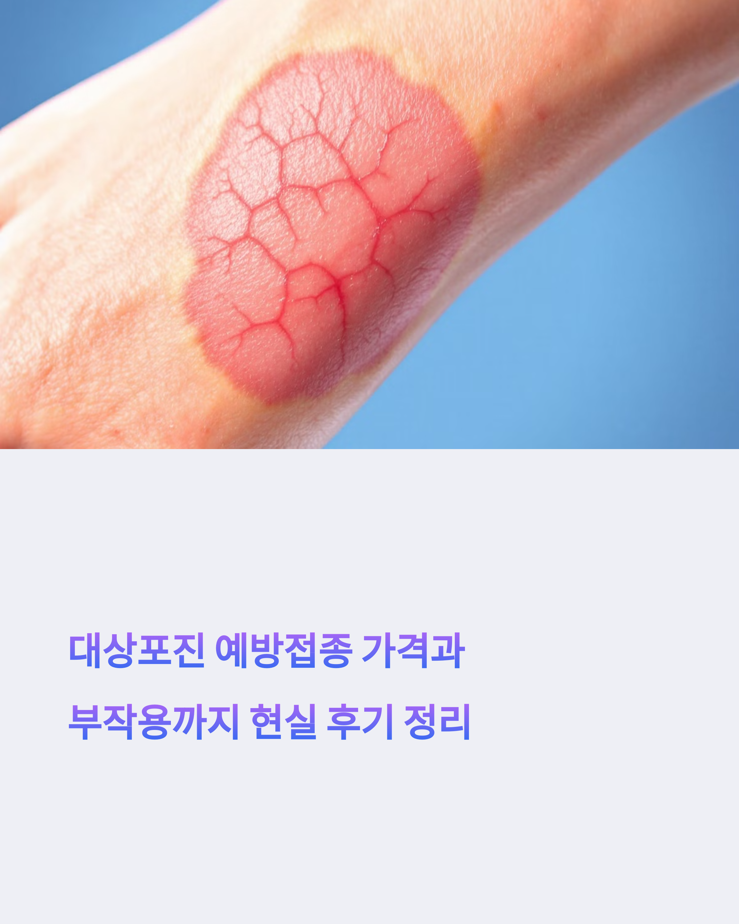 대상포진 예방접종 가격과 부작용까지 현실 후기 정리