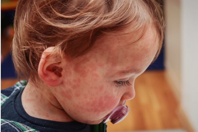 홍역예방접종 성인 홍역 예방접종